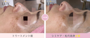 40代女性、洗浄施術6回目写真。13人目、LUX(ラックス)天王寺のシミ取り、シミケア、毛穴洗浄結果写真、効果写真。