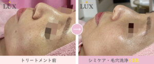 40代女性、シミケア、毛穴洗浄施術11回目写真。14人目、LUX(ラックス)天王寺のシミ取り、シミケア、シミ取り、毛穴洗浄結果写真、効果写真。