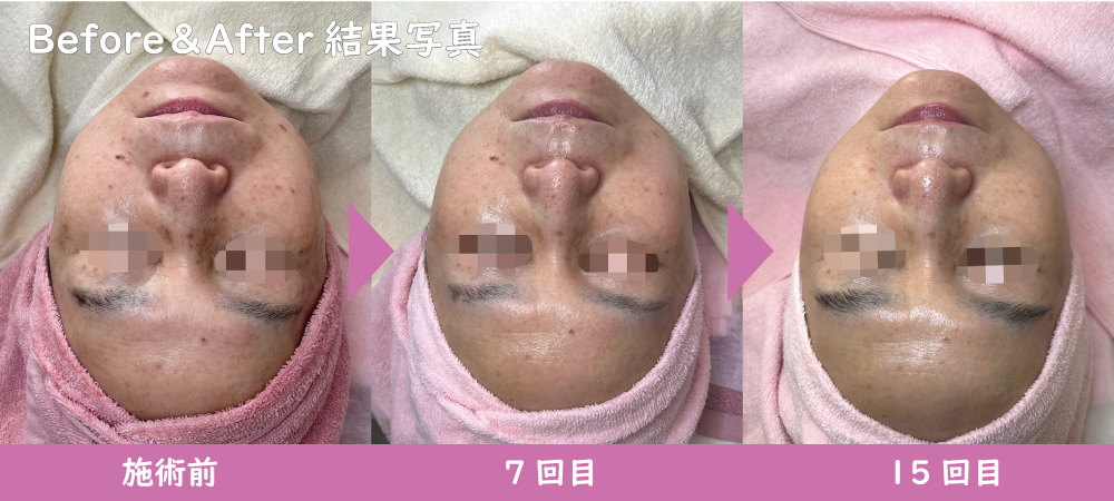 50代女性「シミ・シワ・毛穴」悩みがあるお客様「結果写真」施術前、施術7回目、施術15回目の効果/LUX天王寺【シミ取り、シミケア、毛穴洗浄施術】