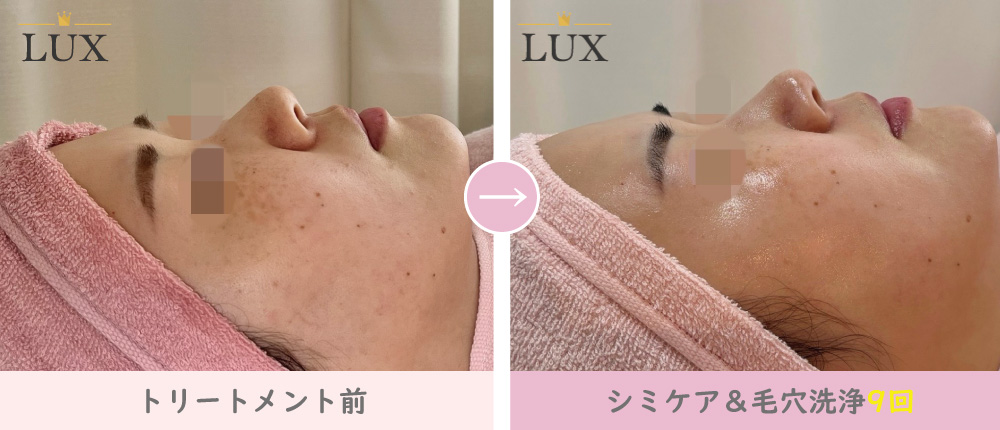 30代 シミケア(シミ取り)毛穴洗浄9回目写真。31人目、LUX(ラックス)天王寺のシミ取り、シミケア、シミ取り、毛穴洗浄結果写真、効果写真。