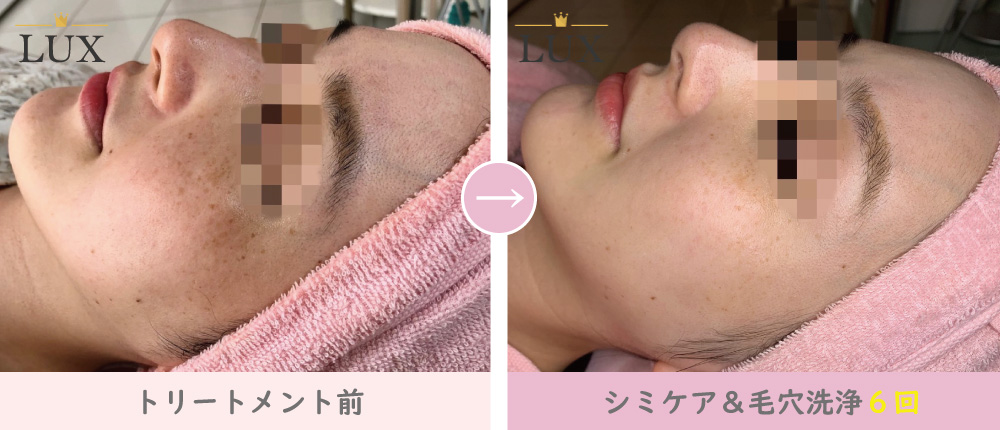 35歳 シミケア(シミ取り)・毛穴洗浄6回目写真。32人目、LUX(ラックス)天王寺のシミ取り、シミケア、シミ取り、毛穴洗浄結果写真、効果写真。