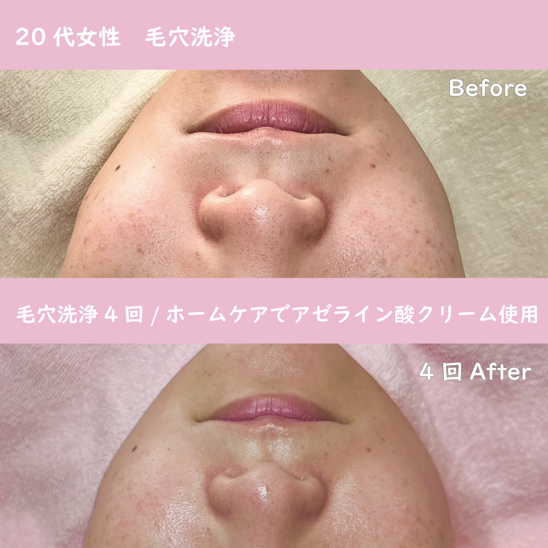 毛穴洗浄の効果を長持ちさせたいなら「アゼライン酸クリーム」がおすすめ！アゼライン酸クリームと毛穴洗浄結果写真