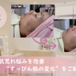 長年の肌荒れ悩みを「シミケアと毛穴洗浄」で改善“すっぴん肌の変化”を写真でご紹介LUX天王寺