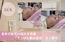 長年の肌荒れ悩みを「シミケアと毛穴洗浄」で改善“すっぴん肌の変化”を写真でご紹介LUX天王寺