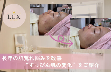 長年の肌荒れ悩みを「シミケアと毛穴洗浄」で改善“すっぴん肌の変化”を写真でご紹介LUX天王寺