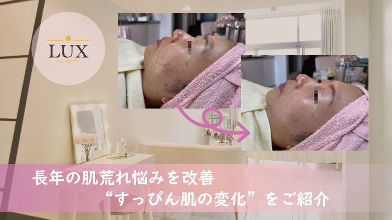 長年の肌荒れ悩みを「シミケアと毛穴洗浄」で改善“すっぴん肌の変化”を写真でご紹介LUX天王寺