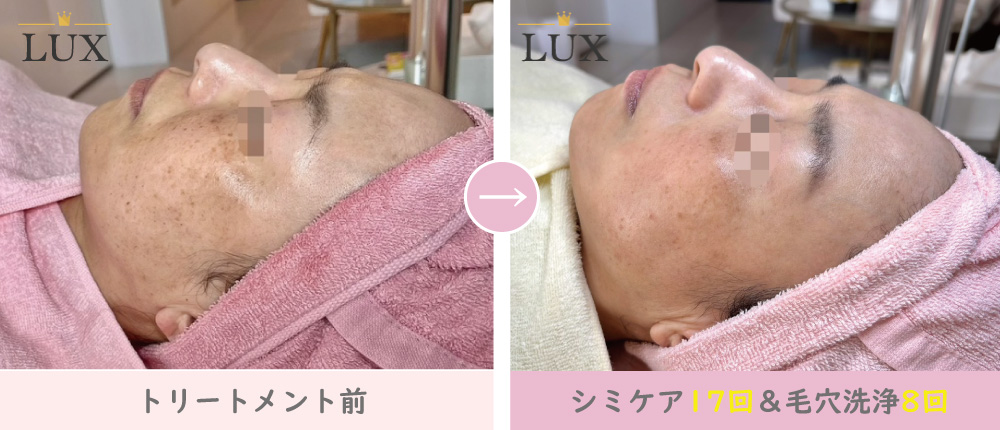 40代女性 シミケア(シミ取り)17回・毛穴洗浄8回目写真。34人目、LUX(ラックス)天王寺のシミ取り、シミケア、シミ取り、毛穴洗浄結果写真、トラネキサム酸美容液使用の効果写真。