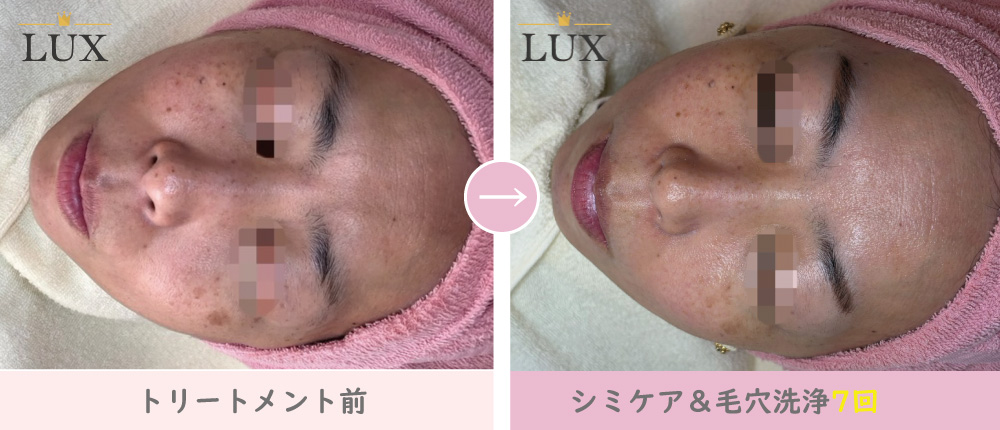 40代女性 シミケア(シミ取り)7回・毛穴洗浄7回目写真。35人目、LUX(ラックス)天王寺のシミ取り、シミケア、シミ取り、毛穴洗浄結果写真